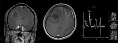 Middle cerebral artery infarction, A rare complication of intracranial cryptococcoma in an immunocompetent patient: A case report and literature review
